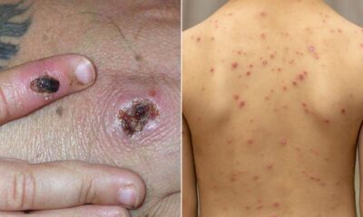 monkeypox:-how-is-it-different-from-chickenpox?