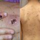 monkeypox:-how-is-it-different-from-chickenpox?