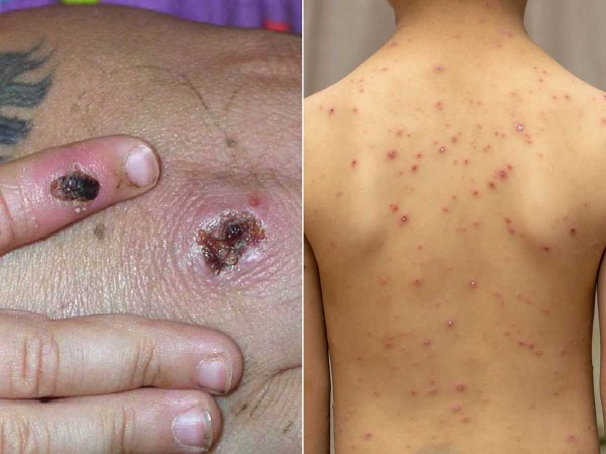 monkeypox:-how-is-it-different-from-chickenpox?